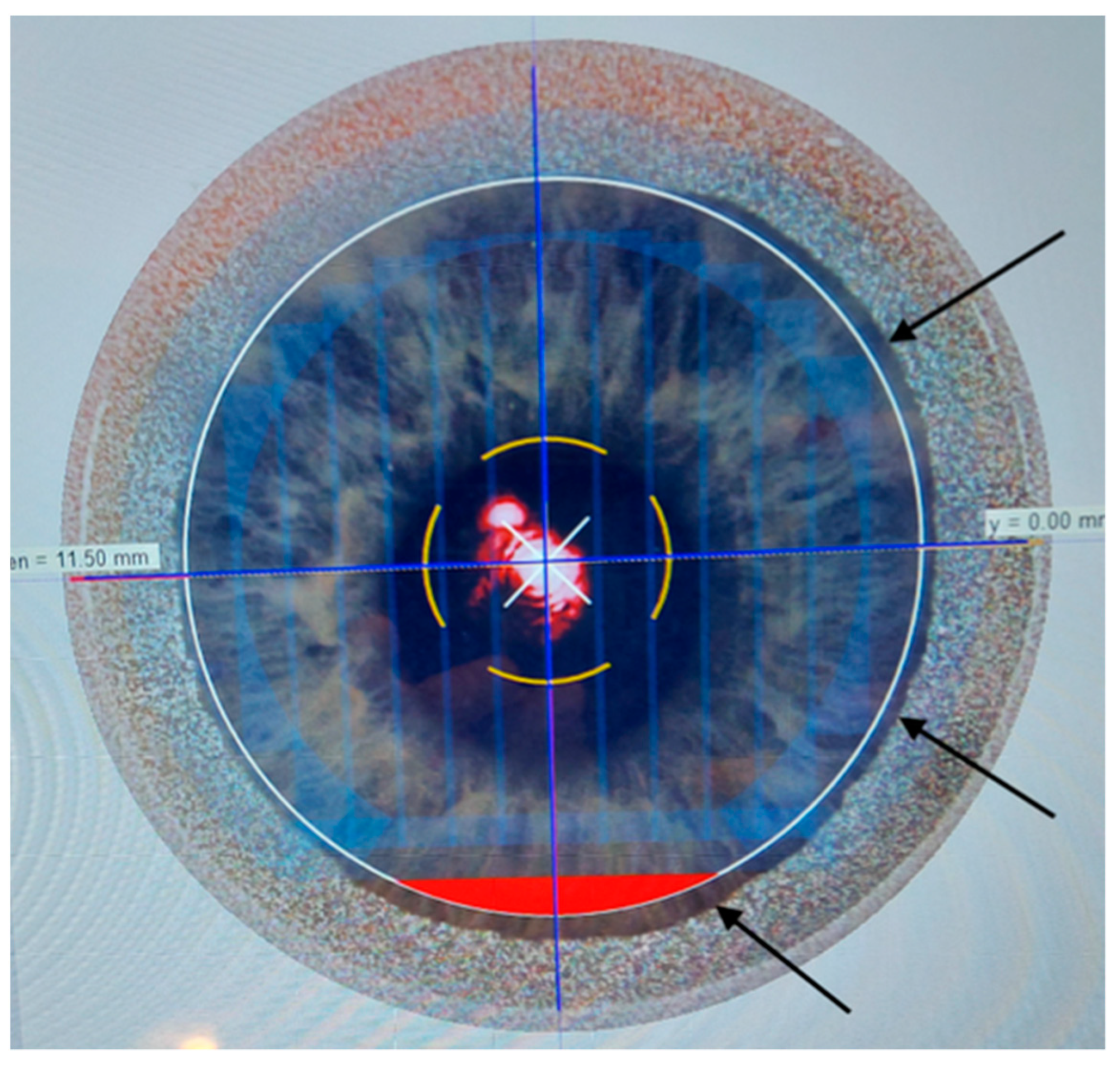 Creation of a Corneal Flap for Laser In Situ Keratomileusis