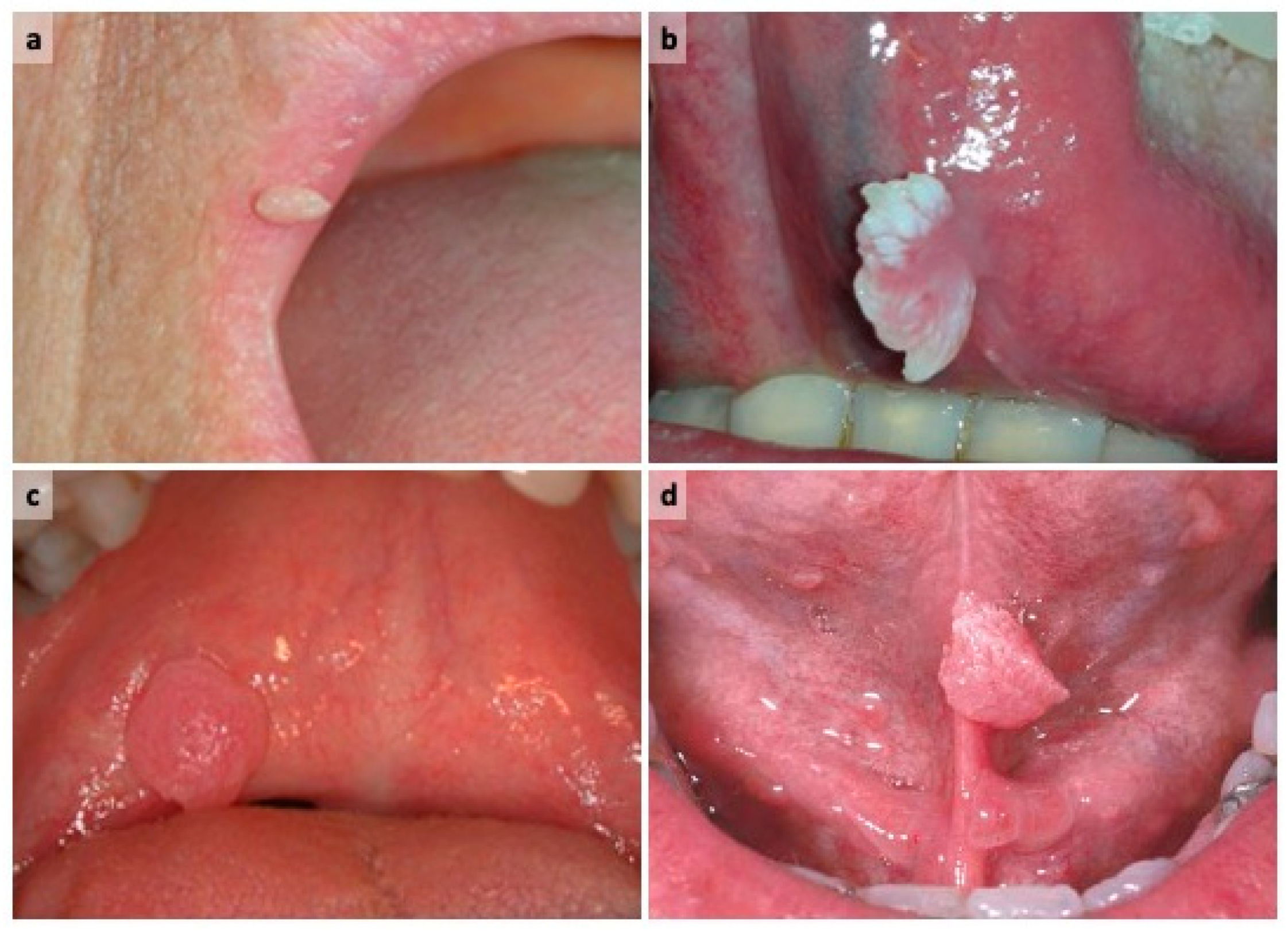 papilloma lesion on tongue)