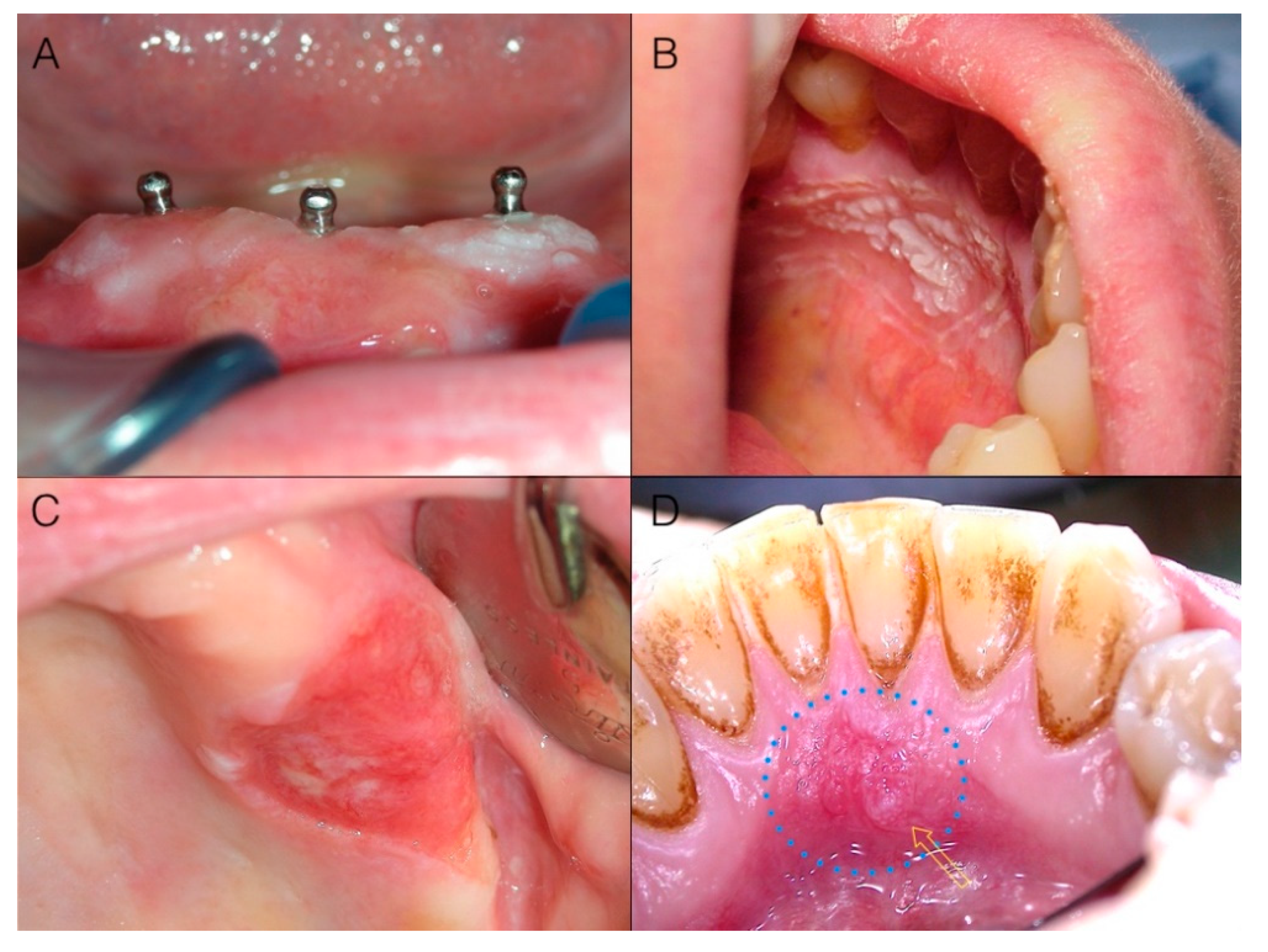 late squamous cell carcinoma