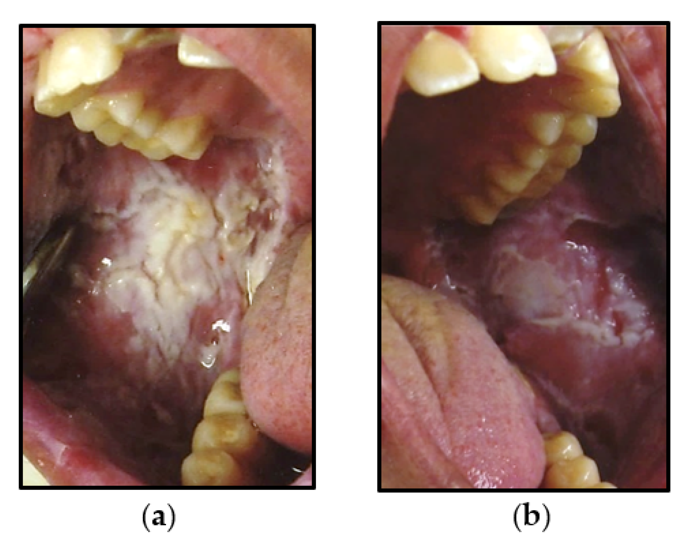 Oral | Free Full-Text | White Sponge Nevus, a Rare but Important Entity
