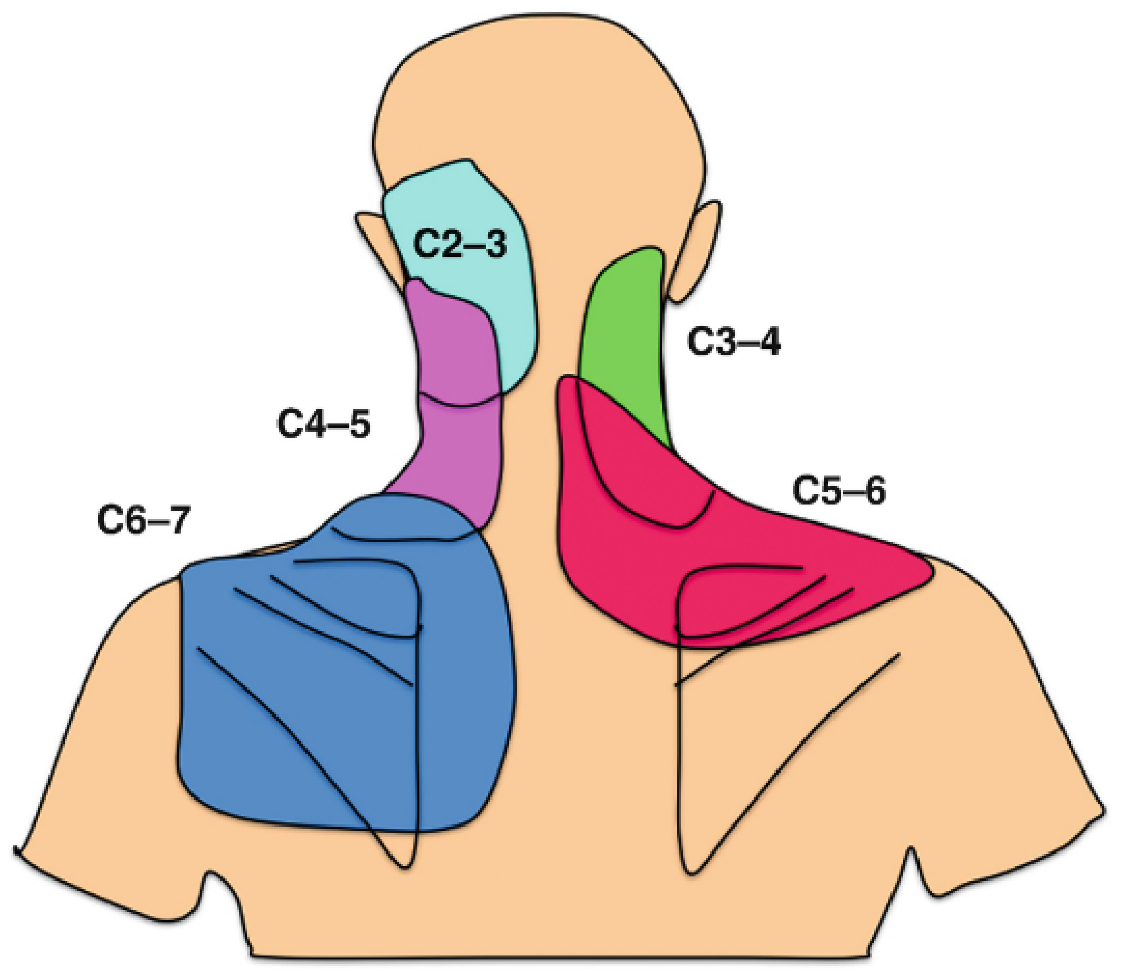gabapentin for radiation pain