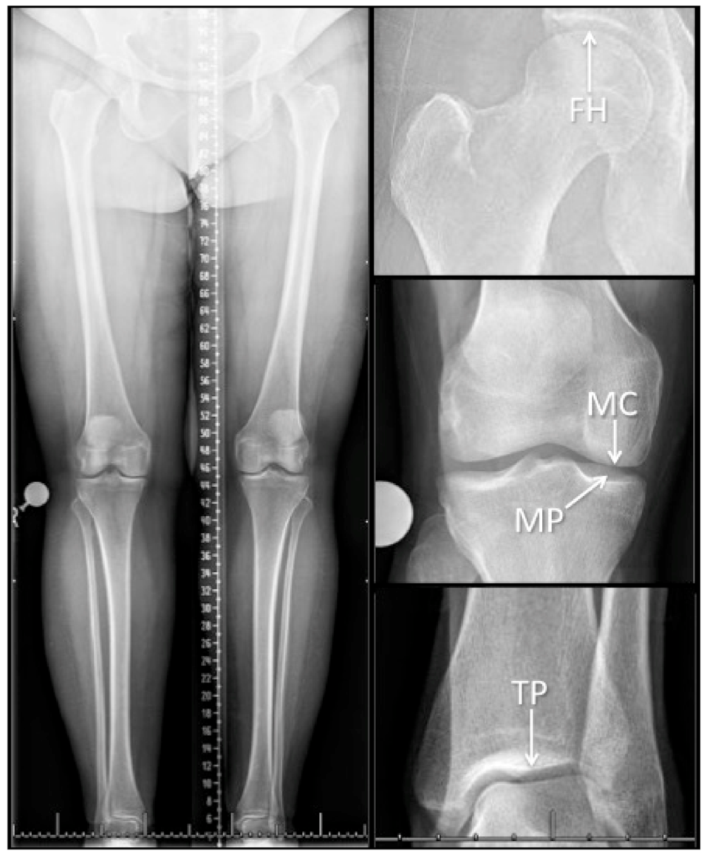 Osteology | Free Full-Text | Normative Values for Femoral Length, Tibial  Length, and the Femorotibial Ratio in Adults Using Standing Full-Length  Radiography