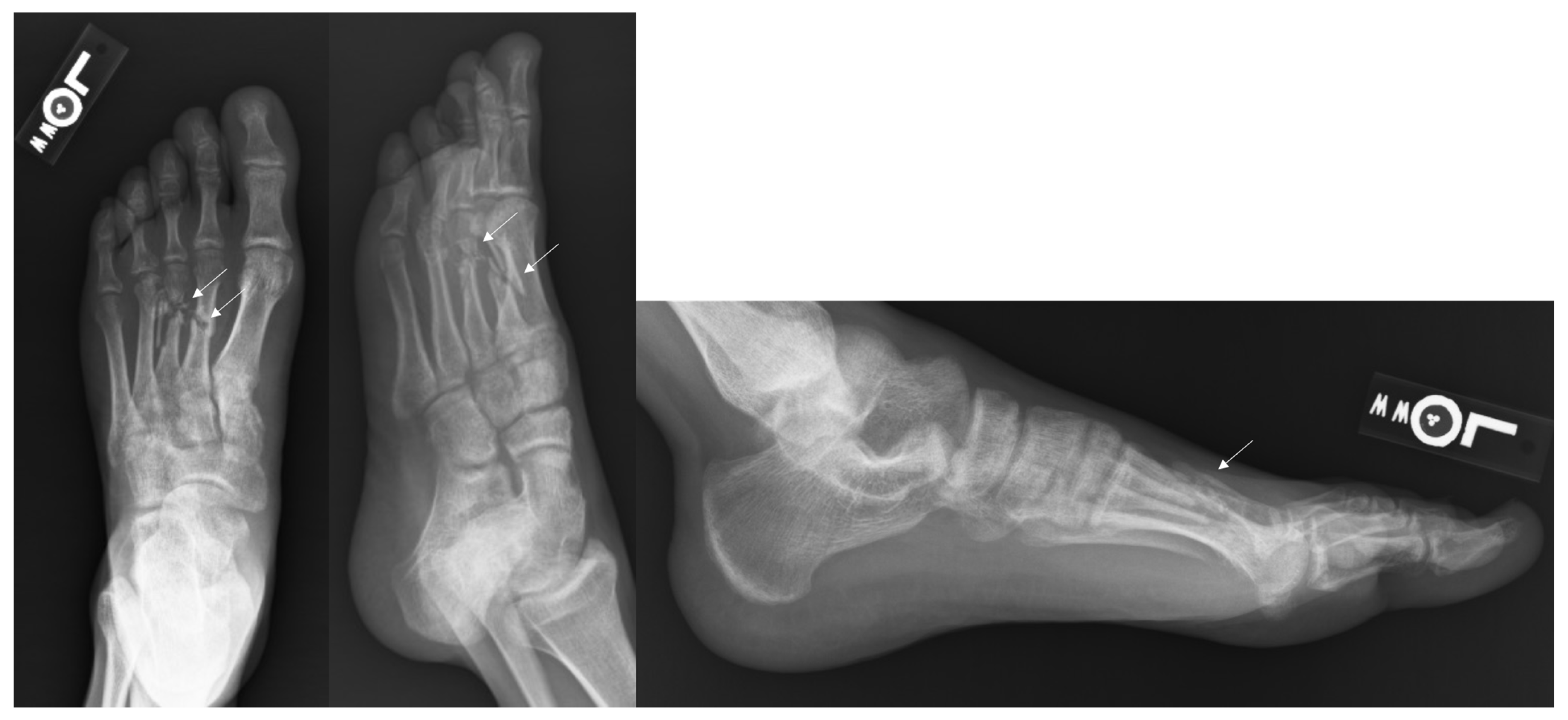 Treatment for metatarsal discount fracture