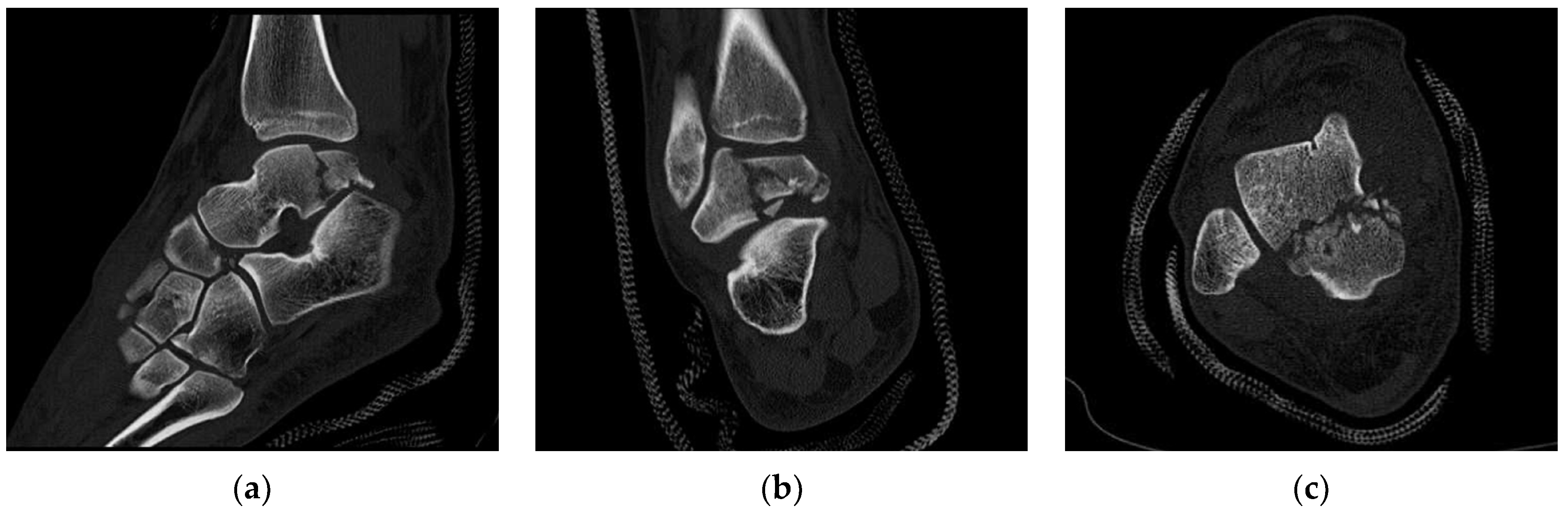 Osteology Free FullText Talus Fractures in Snowboarders A Case Series