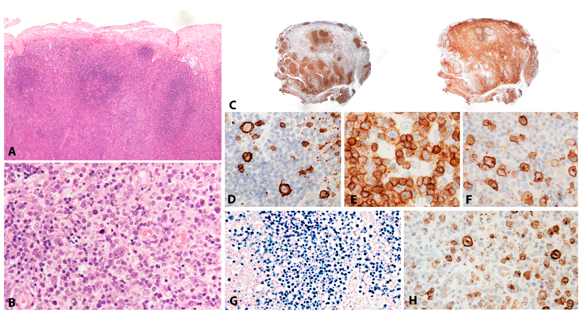 Pathogens | Free Full-Text | EBV-Positive Lymphoproliferations of 