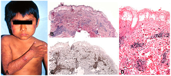 EBV-Positive Lymphoproliferations of B- T- and NK-Cell