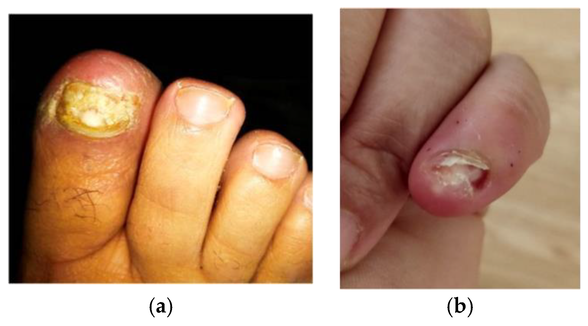 Pseudomonas infection of nail: Green nail syndrome secondary to  onychomycosis - Cosmoderma