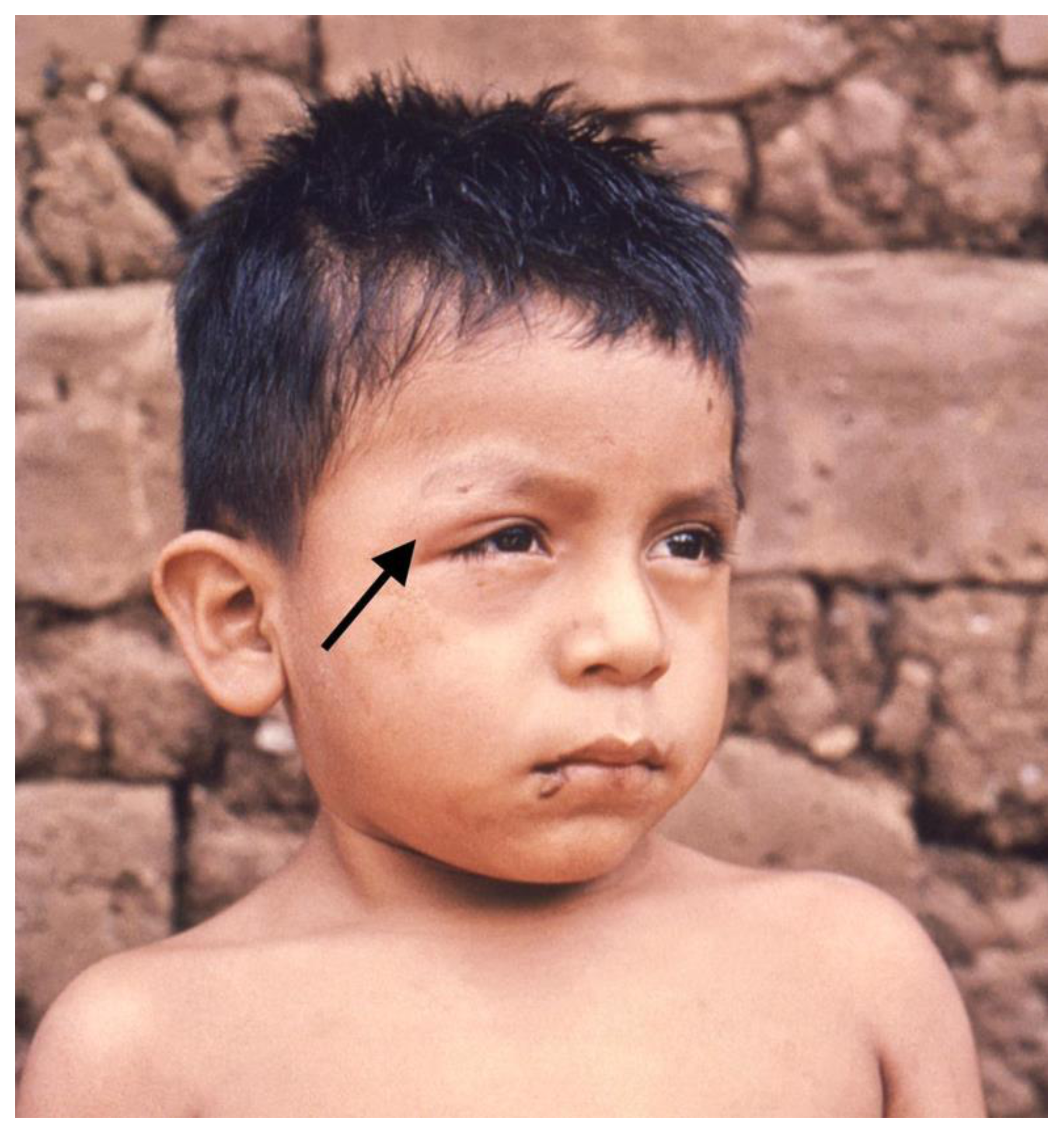 Pathogens | Free Full-Text | Chagas Cardiomyopathy: From Romaña Sign to  Heart Failure and Sudden Cardiac Death