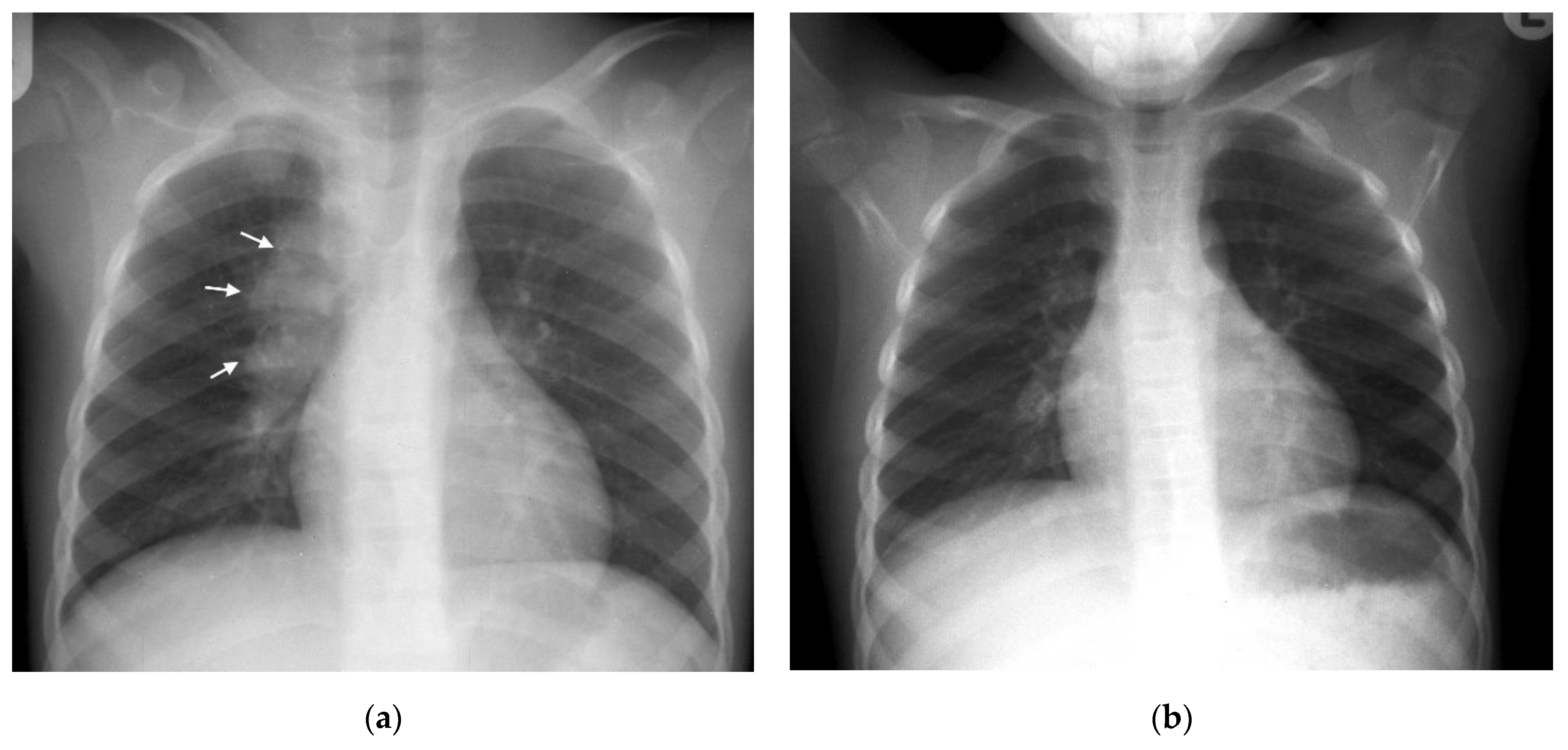 Chest PDF | PDF | Lung | Pneumonia