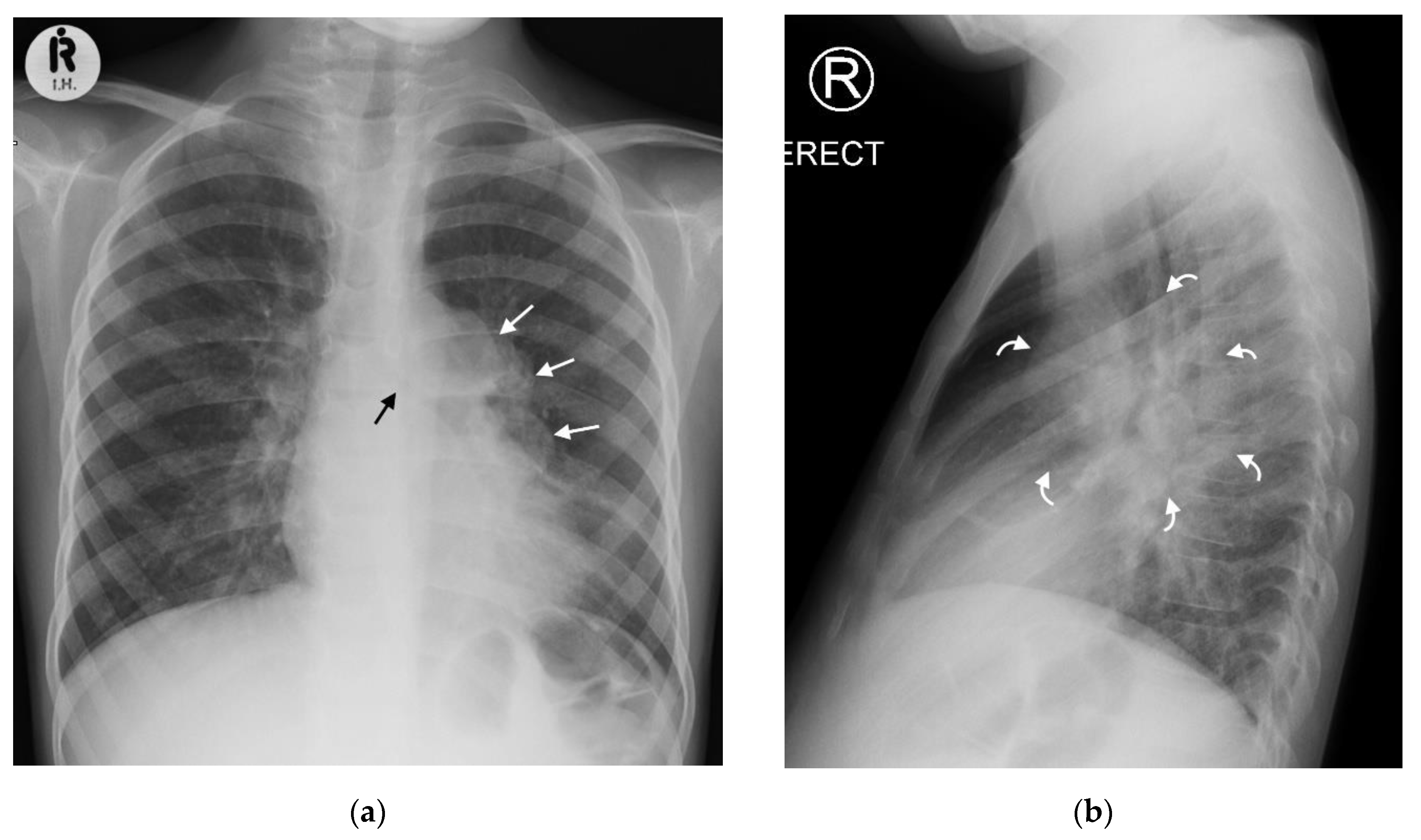 Imaging in pulmonary hydatid cysts