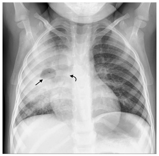 Signet ring sign (bronchiectasis) | Radiology Reference Article |  Radiopaedia.org