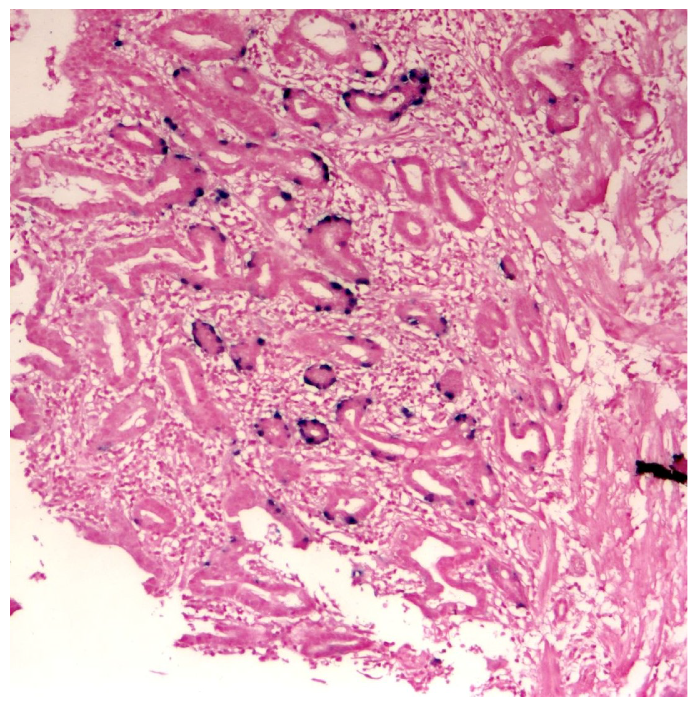 carpus és papilloma