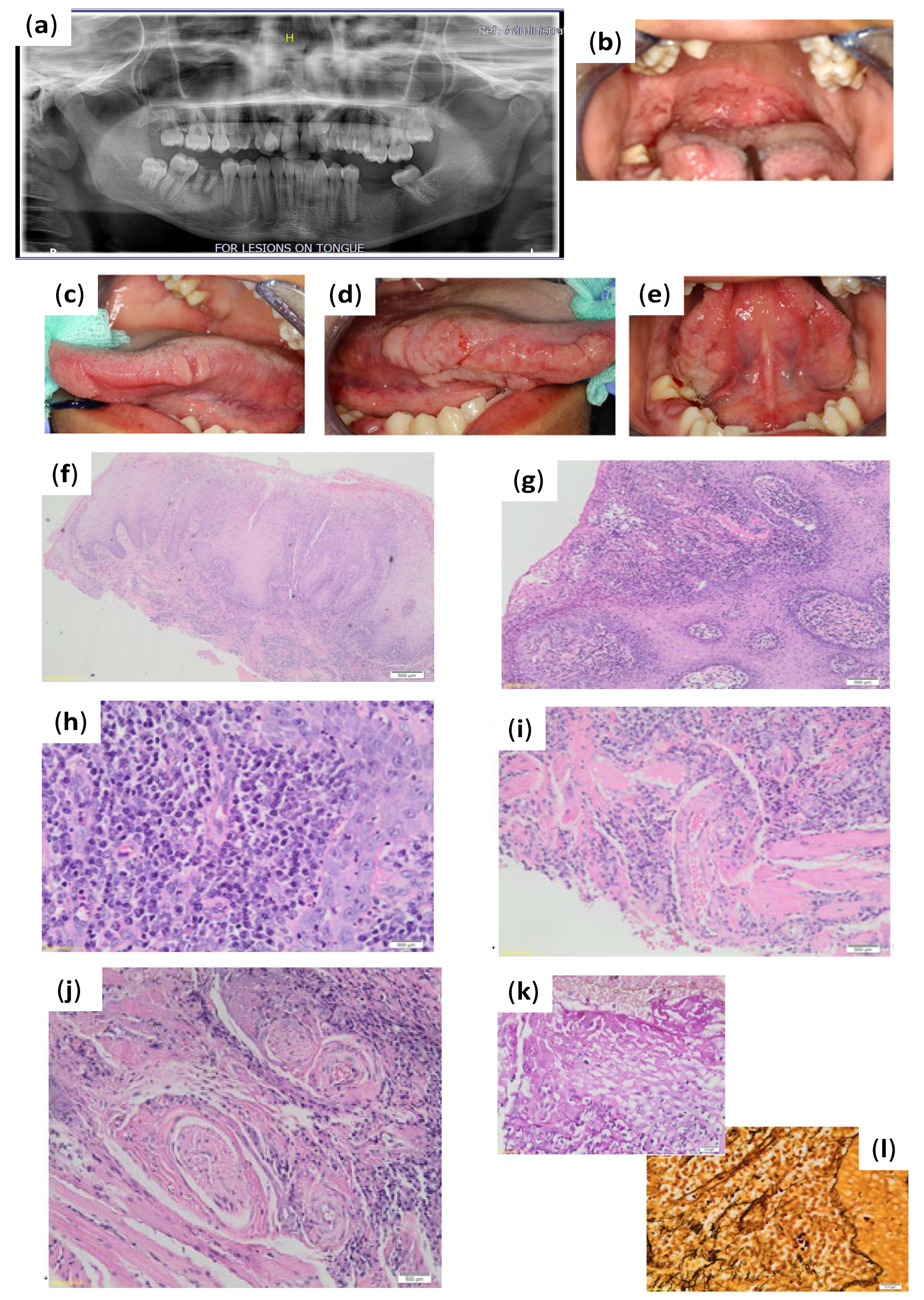 leukoplakia condilom