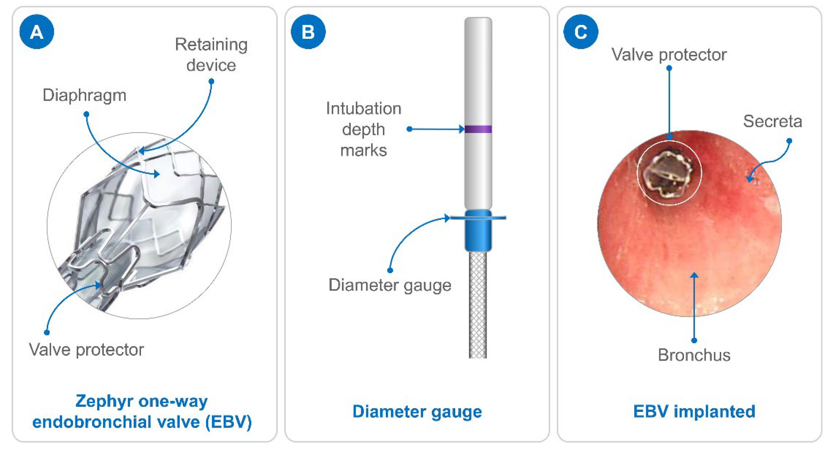Pathogens Free FullText Endobronchial Valve Treatment of