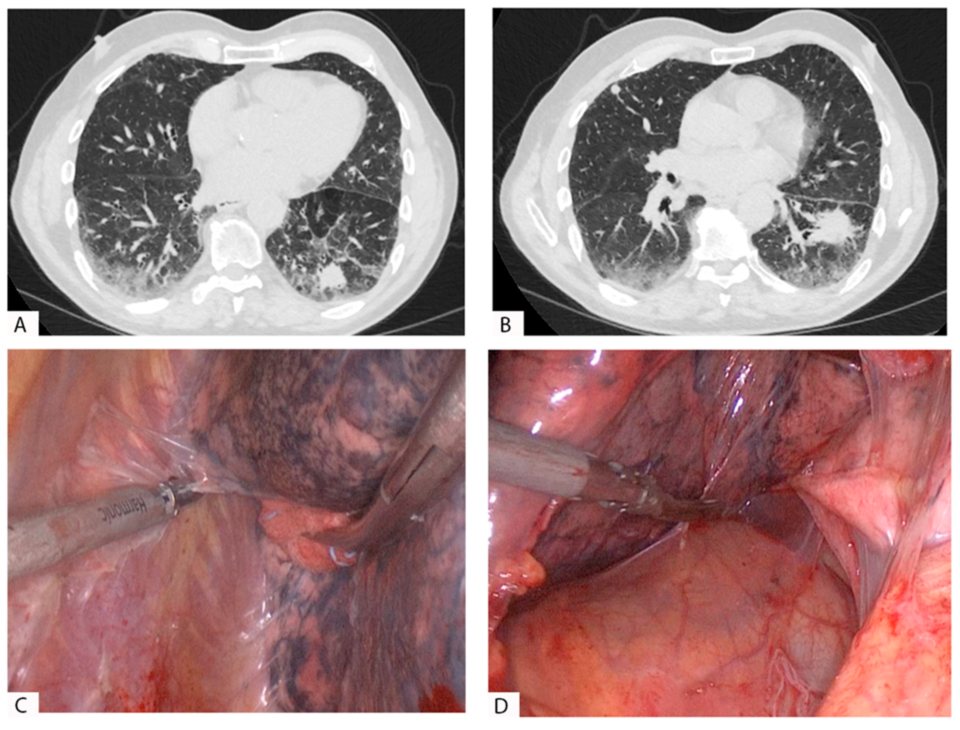 Pulmonary nodules in African migrants caused by chronic