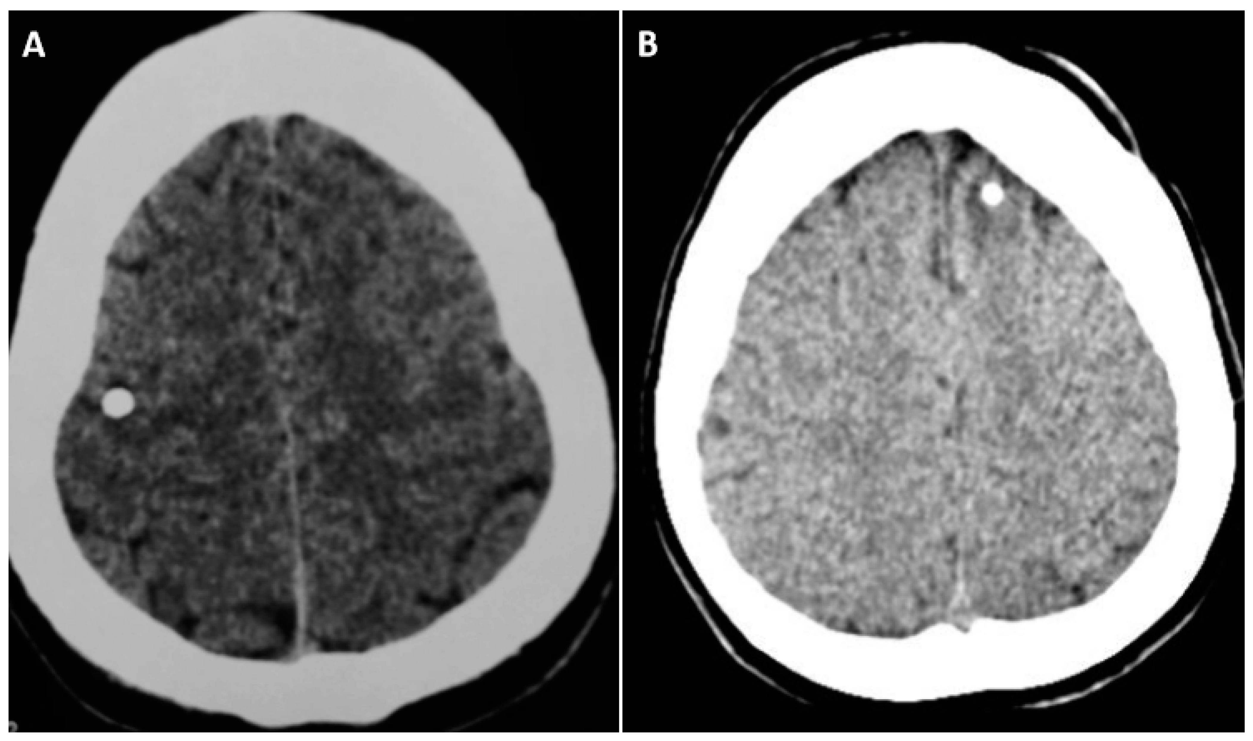 gabapentin focal seizures