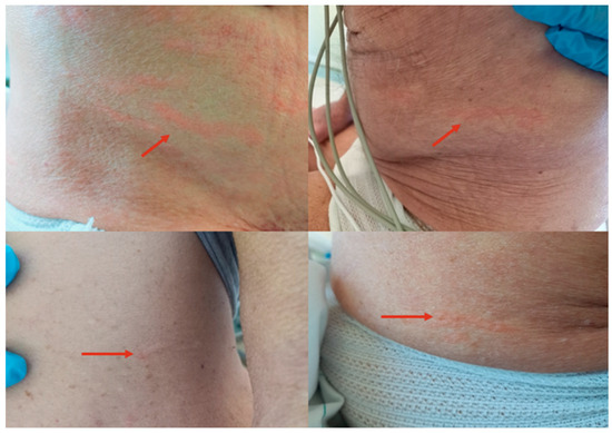 Dermatological Presentation of Strongyloides stercoralis Infection in ...