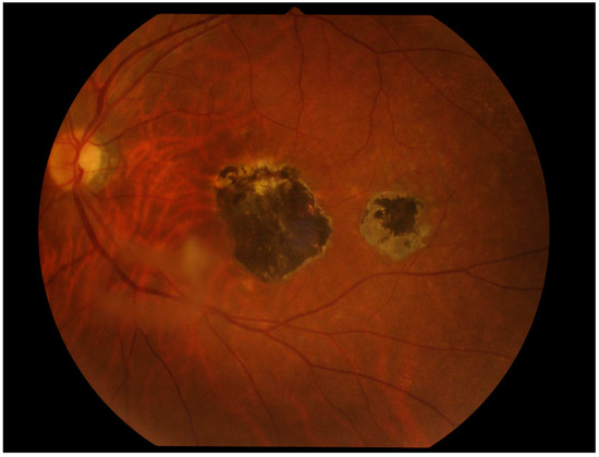 Ocular Toxoplasmosis: Advances in Toxoplasma gondii Biology, Clinical ...