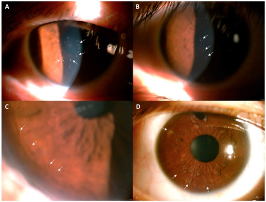 Cytomegalovirus Infection of the Anterior Segment: Corneal