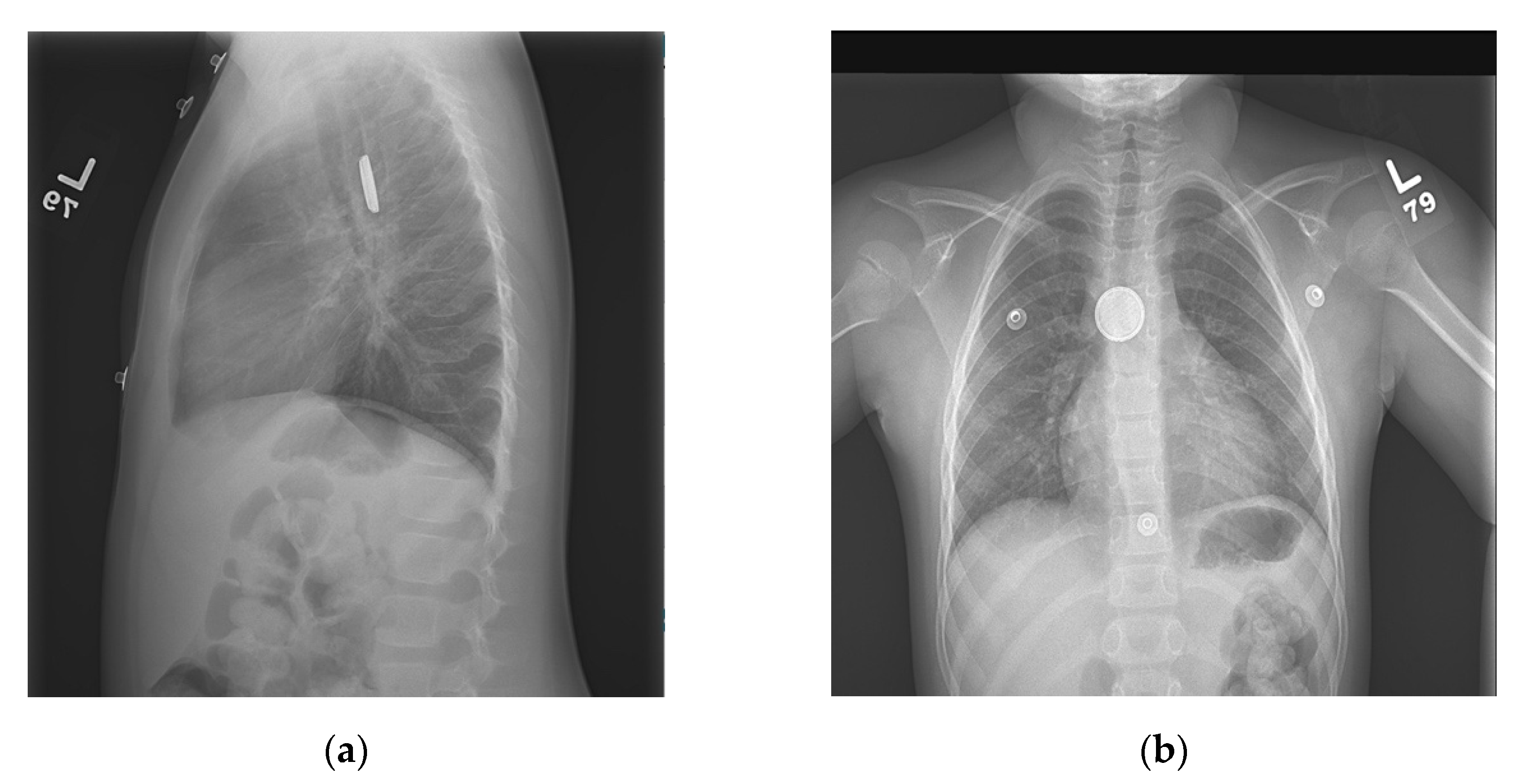 Pediatric Reports Free FullText Endoscopic Evaluation for