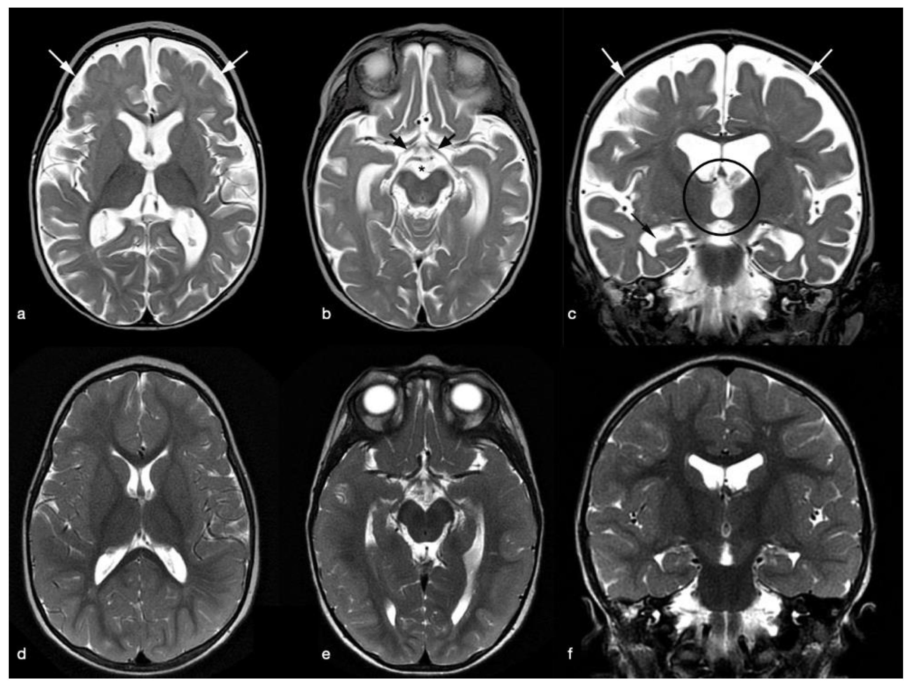 Brain 12. Перивентрикулярная гетеротопия. Перивентрикулярная Узловая гетеротопия. Незавершенная миелинизация мрт. Субэпендимарная гетеротопия.