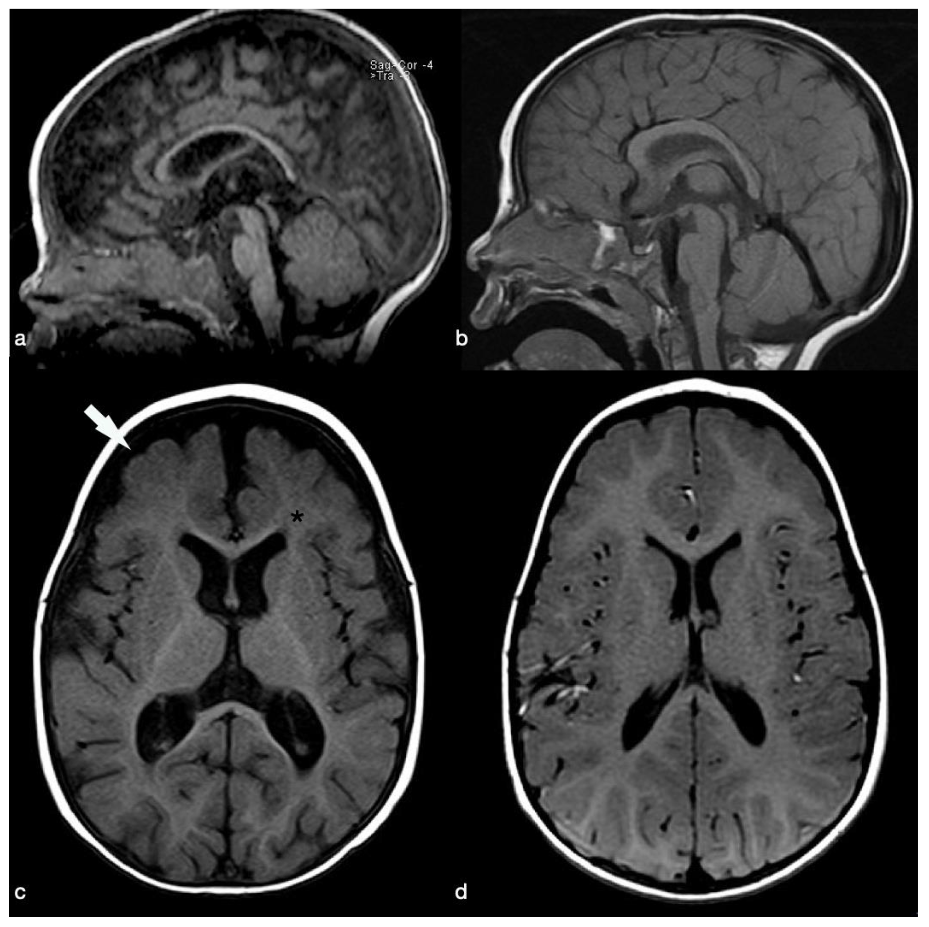 Clinical and Brain Imaging Findings in a Child with Vitamin
