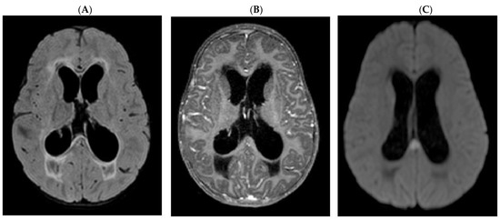 健康・医学 Tuberculosis Tuberculosis - The Lancet