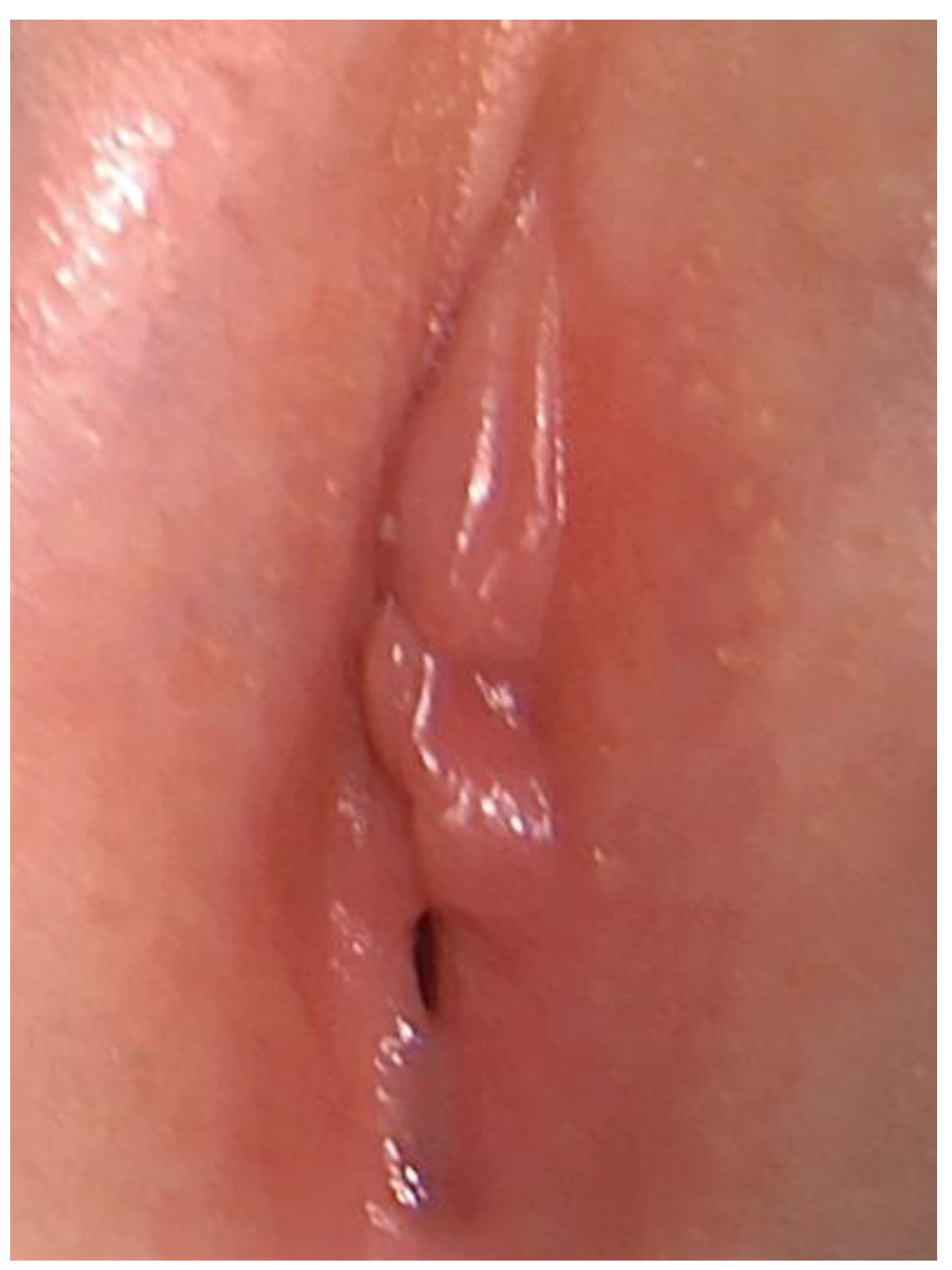 prepubertAL VAGINA 