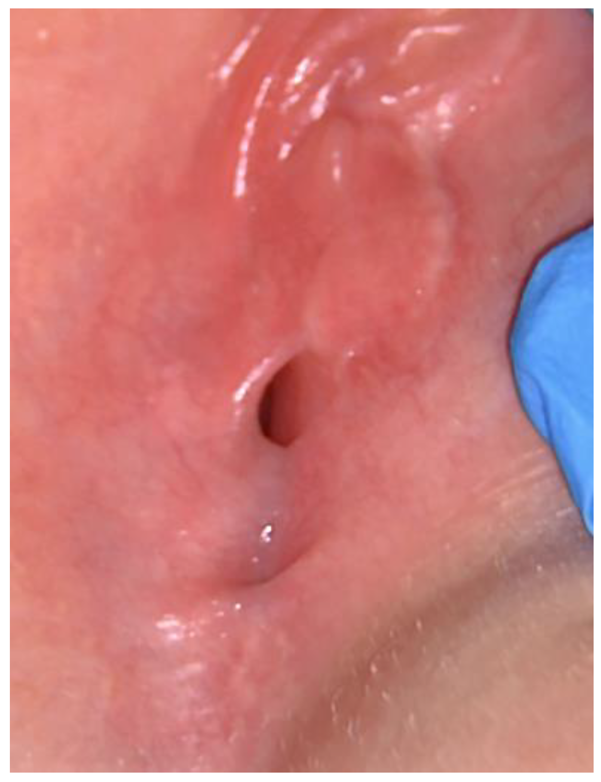 closeup Prepuberty pussy peeing Treatment of Prepubertal Labial Adhesions with Topical Estriol +  Testosterone: A Case Report