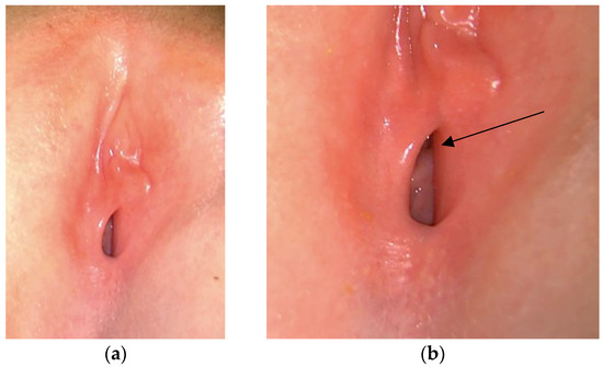 pediatric vulva 