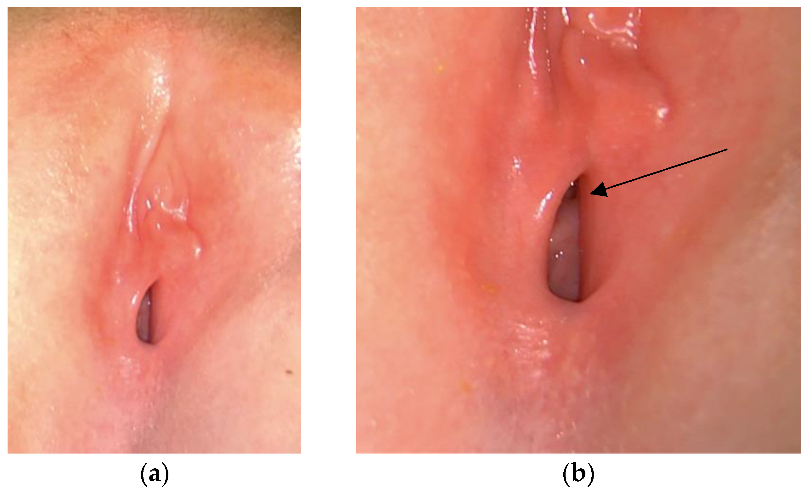 prepubertAL VAGINA 