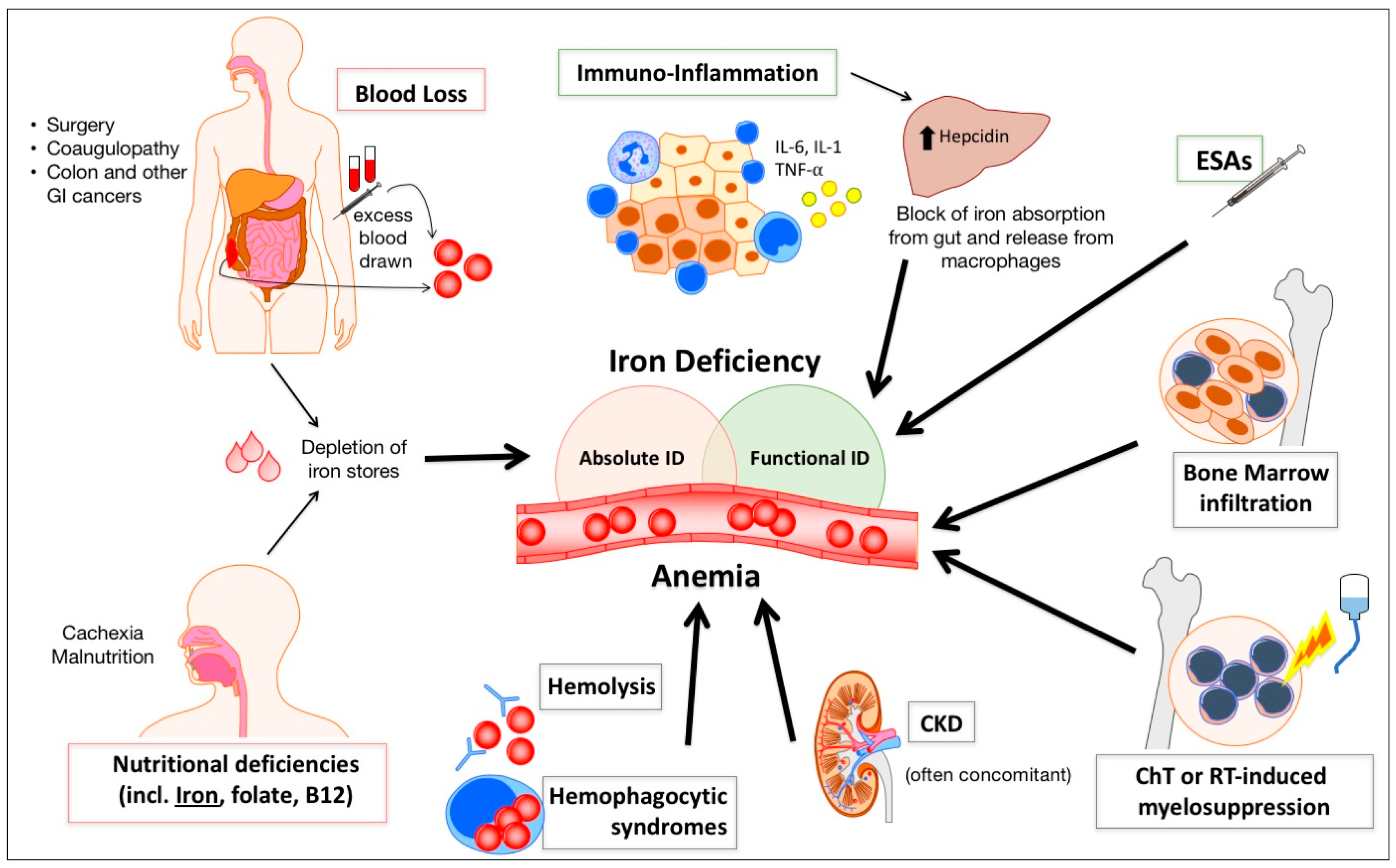 Pharmaceuticals | Free Full-Text | Anemia and Iron Deficiency in Cancer Patients: Role of Iron Replacement Therapy Pharmaceuticals | Free Full-Text | Anemia and Iron Deficiency in Cancer Patients: Role of Iron Replacement Therapy