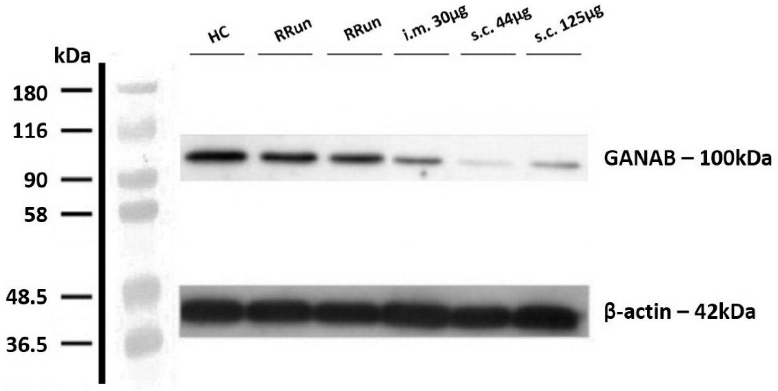 【Mry】！ GANAB as a Novel Biomarker in Multiple Sclerosis