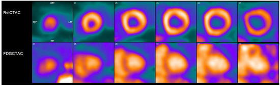 PET Imaging in Cardiac Sarcoidosis: A Narrative Review with Focus on ...