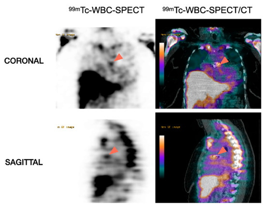 Nuclear Imaging in Infective Endocarditis