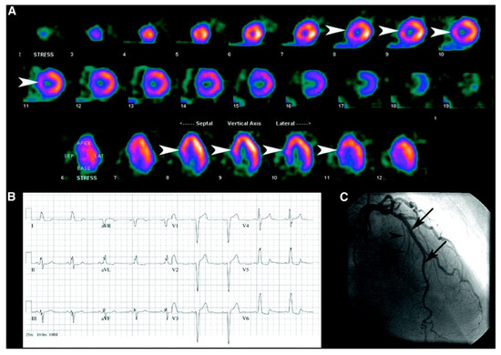 Left Ventricular Strain from Myocardial Perfusion PET Imaging