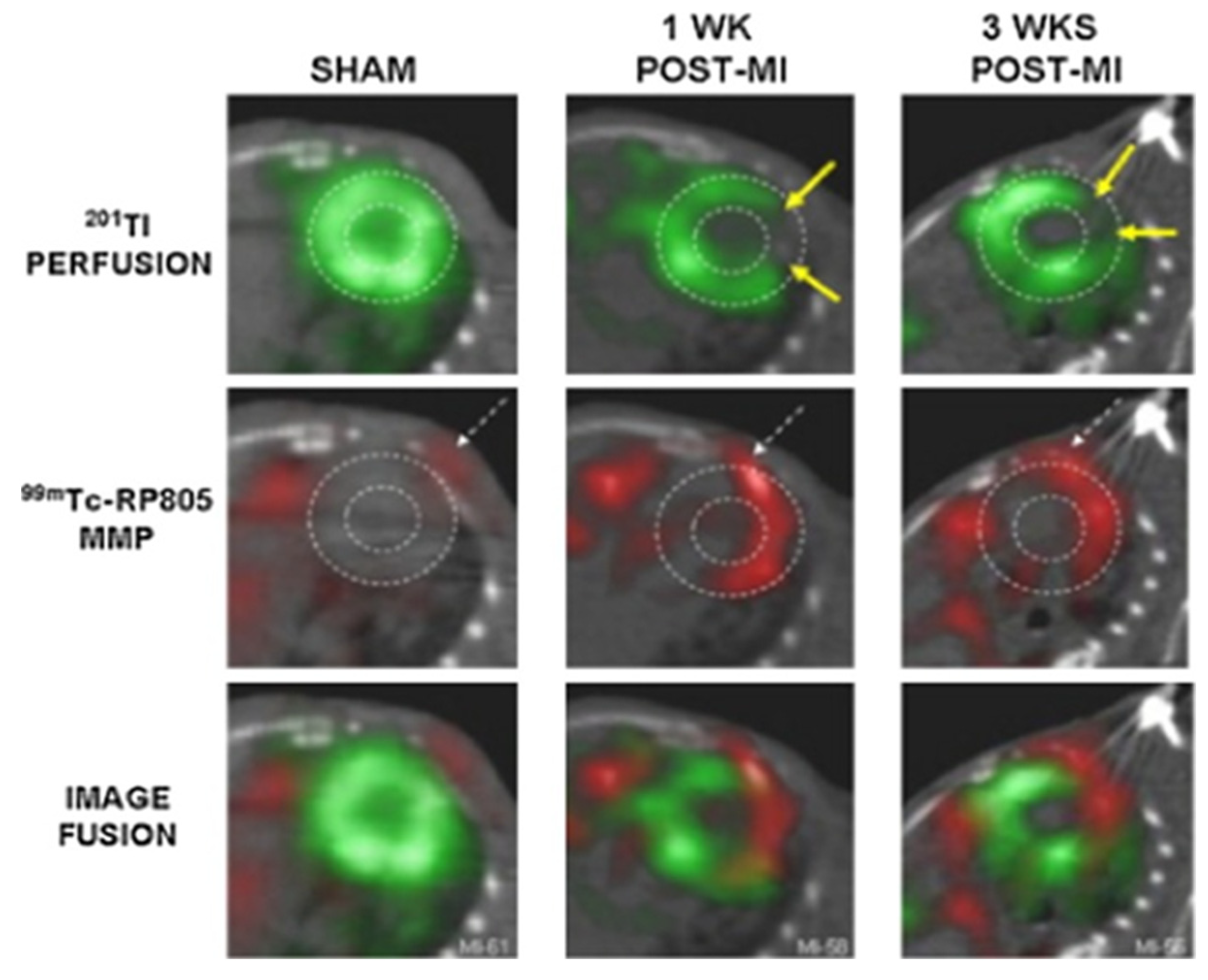 Assessment of Myocardial Viability Using Nuclear Medicine Imaging in  Dextrocardia