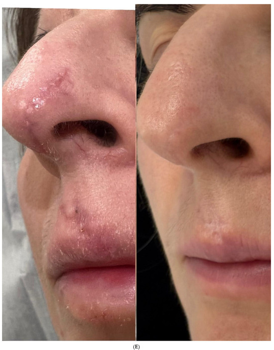 Therapeutic Efficacy of Plant-Derived Exosomes for Advanced Scar