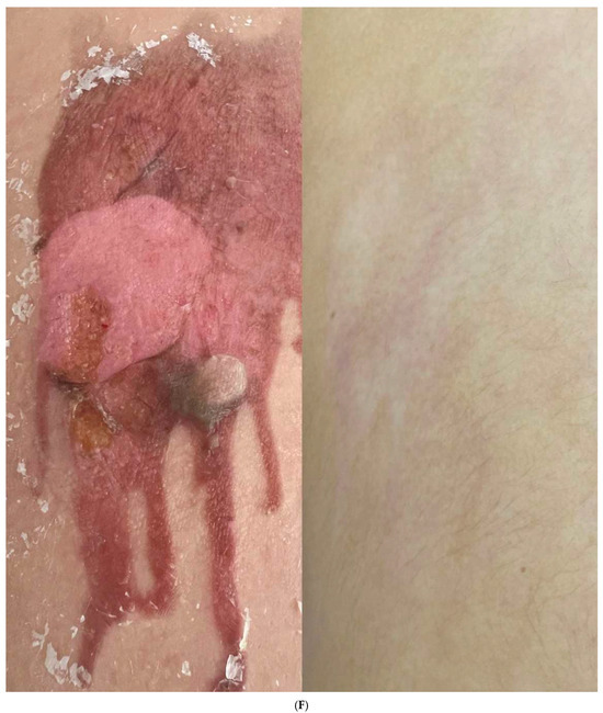 Therapeutic Efficacy of Plant-Derived Exosomes for Advanced Scar
