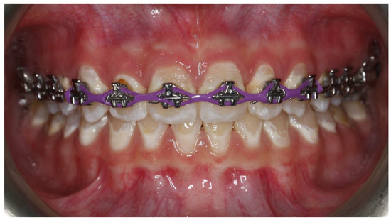 Rubber Bands Braces 101 - Orthodontics Limited