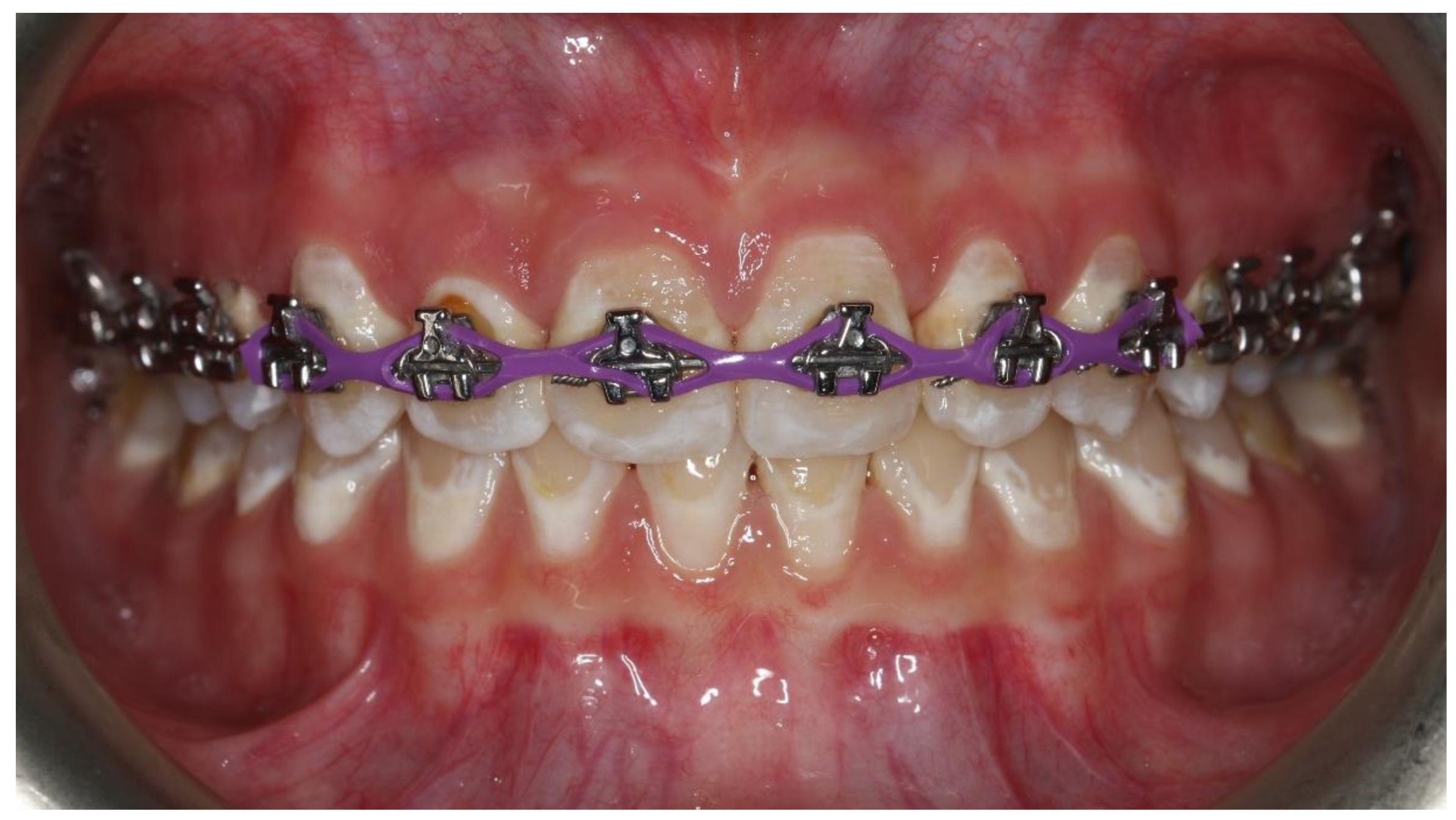 Can You Reuse Rubber Bands for Braces? ANSWERED - Eco Friendly-HQ