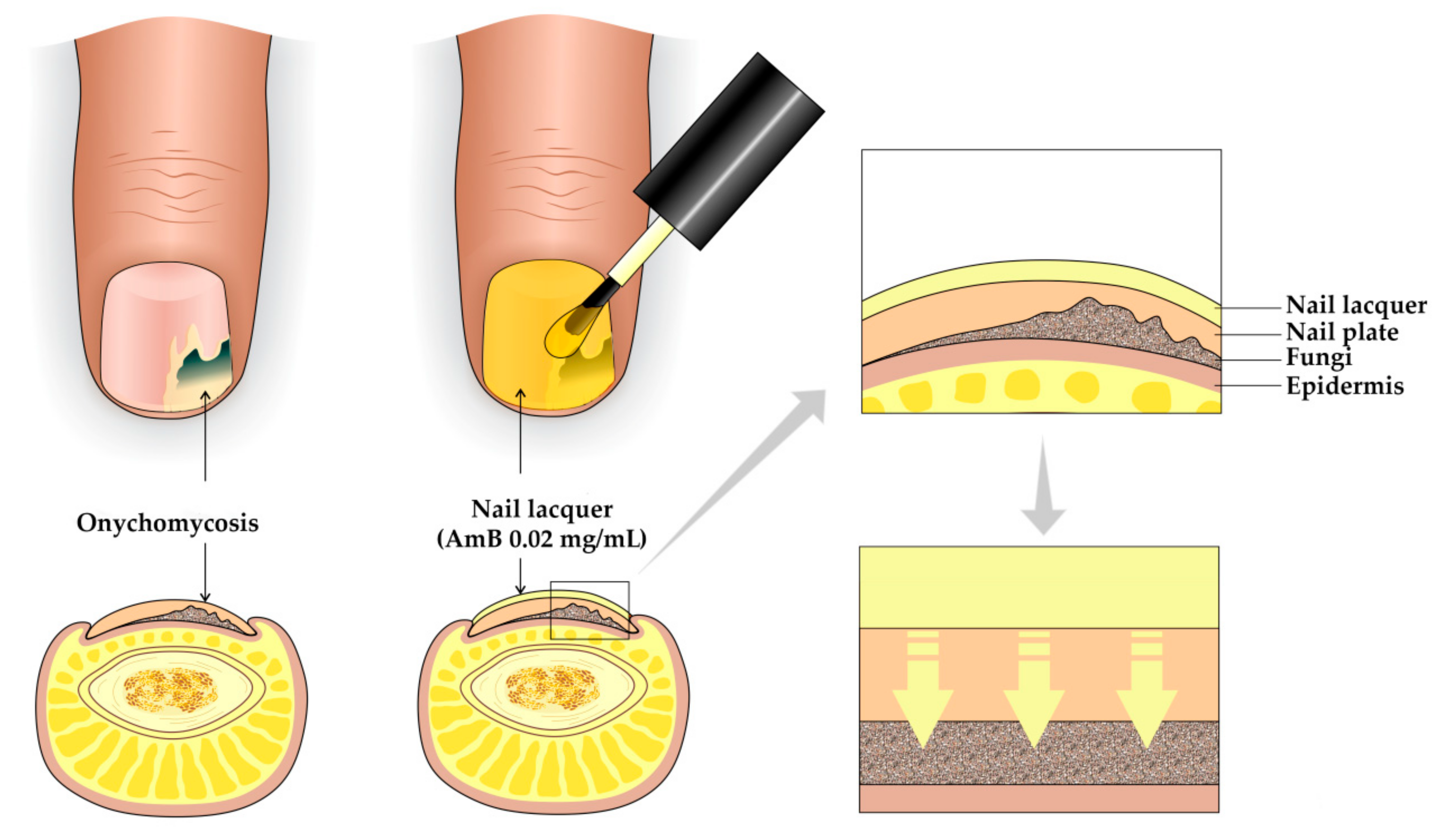 Top 4 Easy Tips to Get Rid of Nail Fungus Caused by Acrylic Nails- Clinic