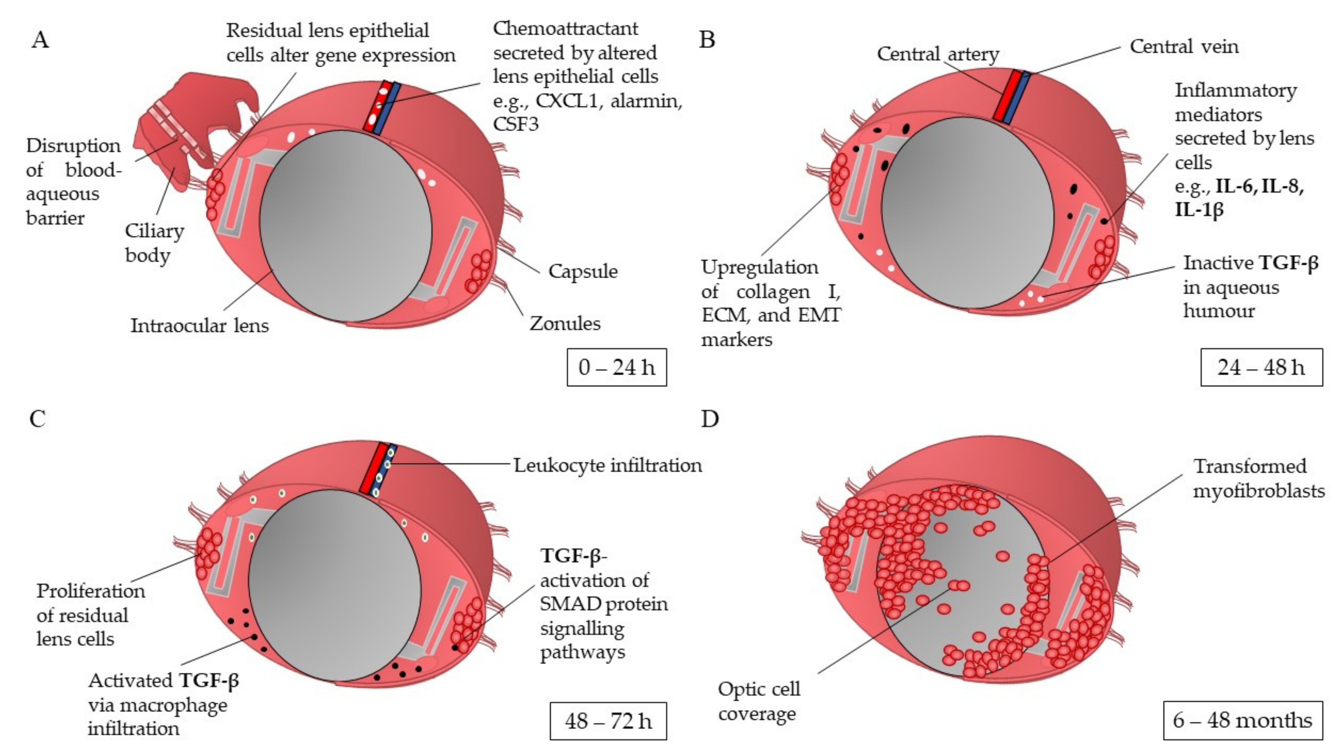 Pharmaceutics | Free Full-Text | Factors Affecting Posterior Capsule  Opacification in the Development of Intraocular Lens Materials