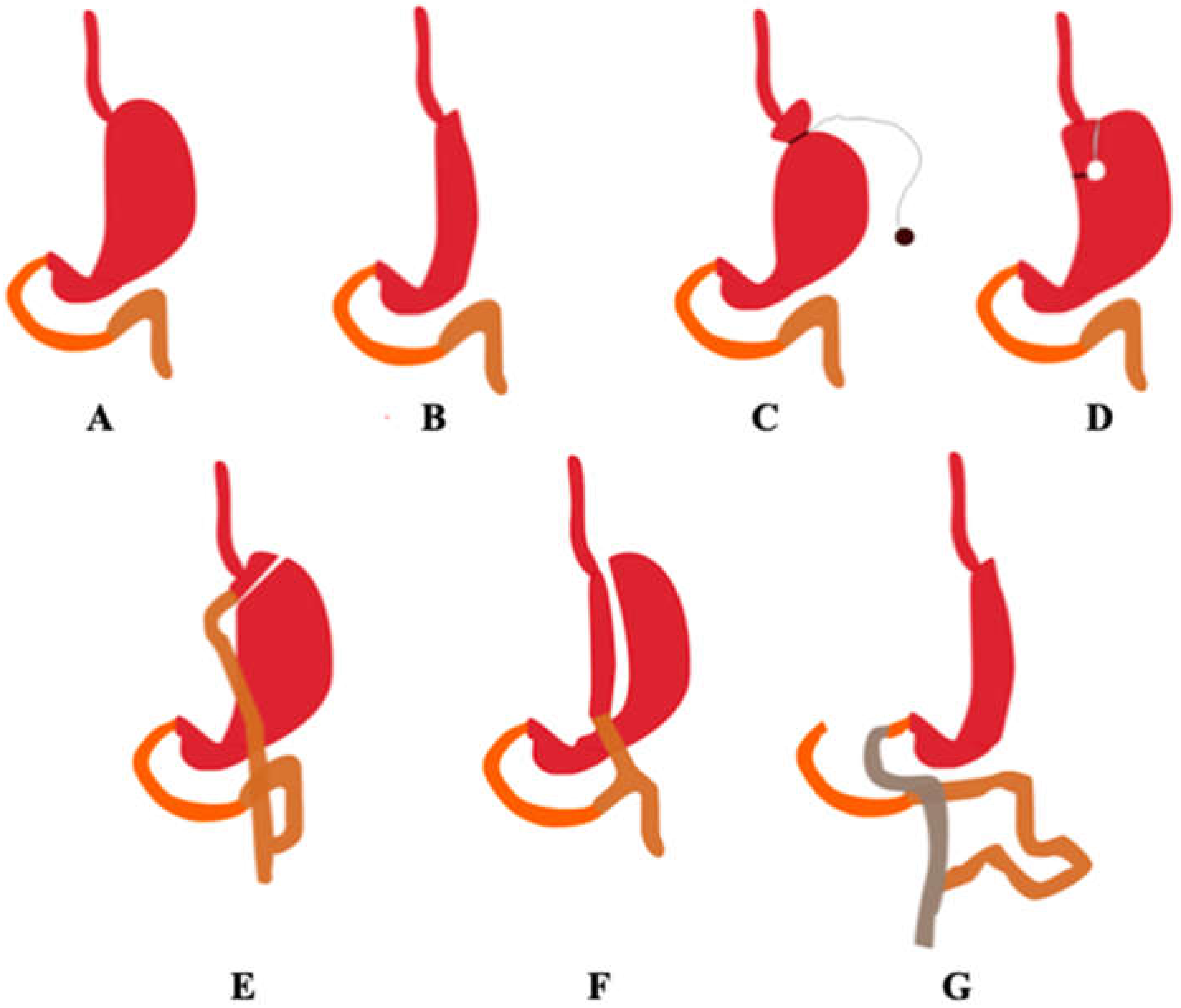 Post Gastrectomy Nutrition Rogers Besto Blog post-gastrectomy-nutrition-rogers-besto-blog