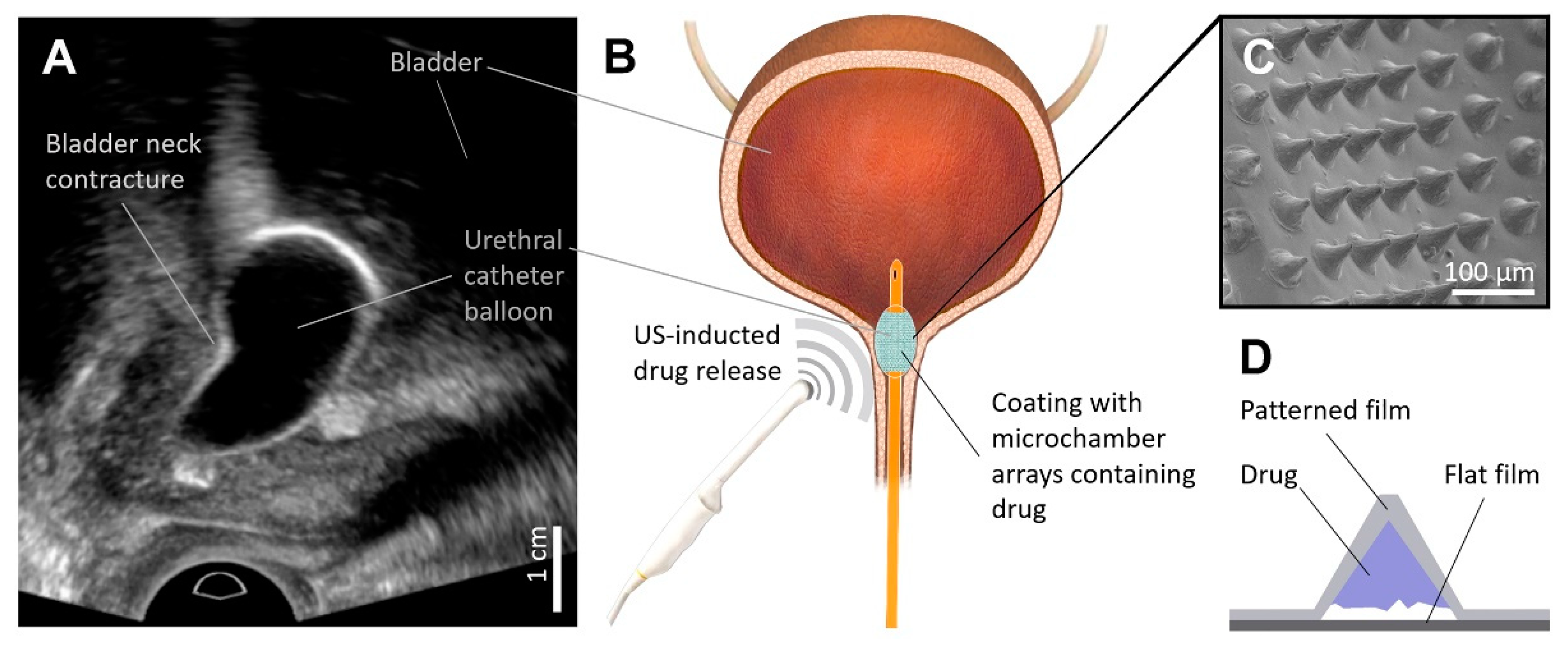 Pharmaceutics Free FullText UltrasoundTriggerable Coatings for Foley Catheter Balloons for