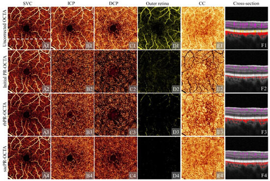 Review of Artifacts and Related Processing in Ophthalmic Optical ...