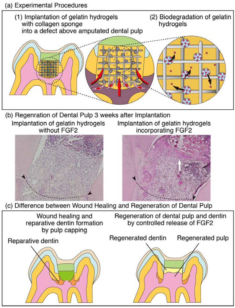 Polymers Free FullText Regeneration Approaches for Dental Pulp and