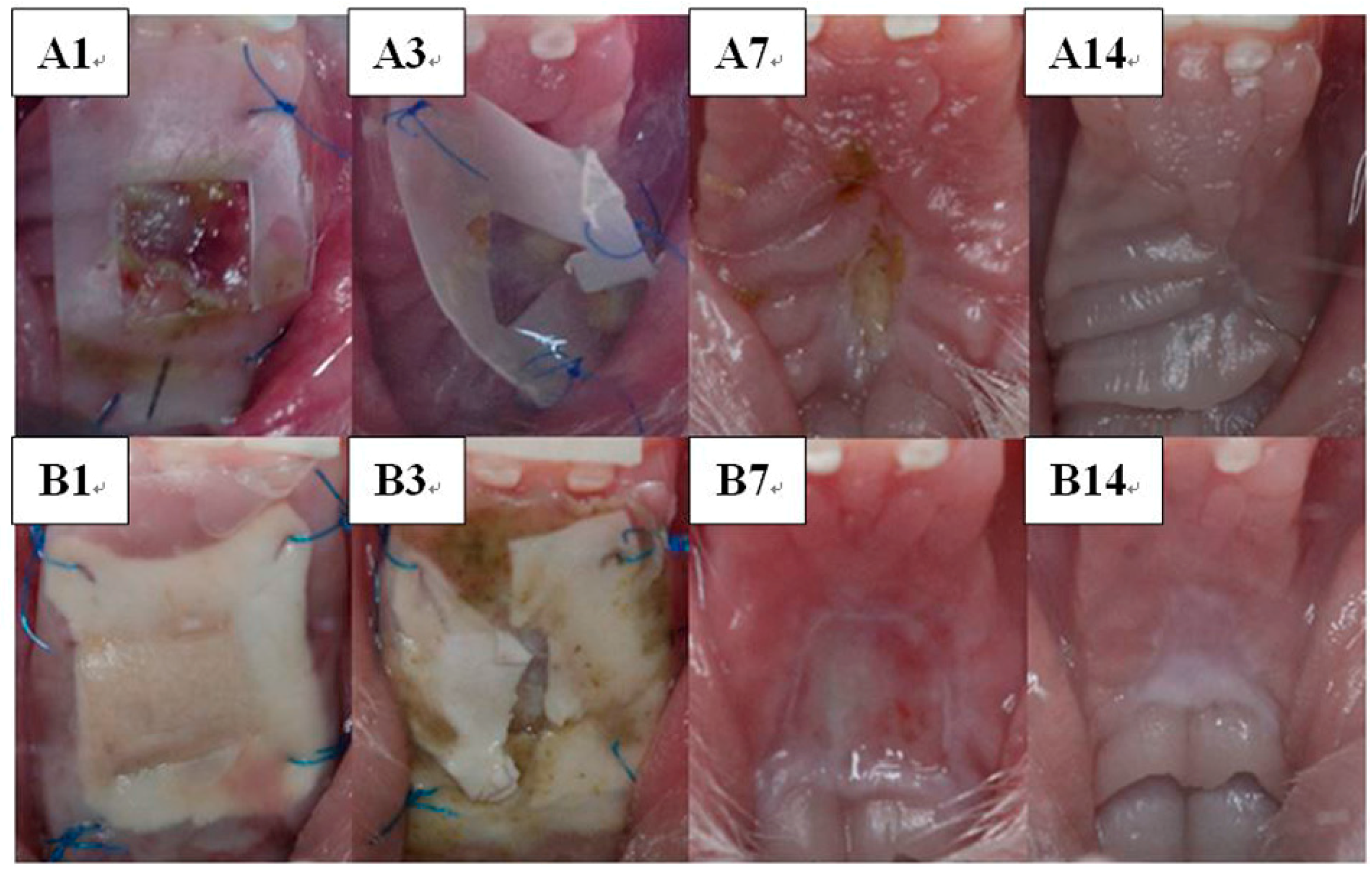 Tooth Pain Relief >> Polymers | Free Full-Text | Fabrication of Multi-Layered Lidocaine and Epinephrine-Eluting PLGA ... Tooth Pain Relief >> Polymers | Free Full-Text | Fabrication of Multi-Layered Lidocaine and Epinephrine-Eluting PLGA ...