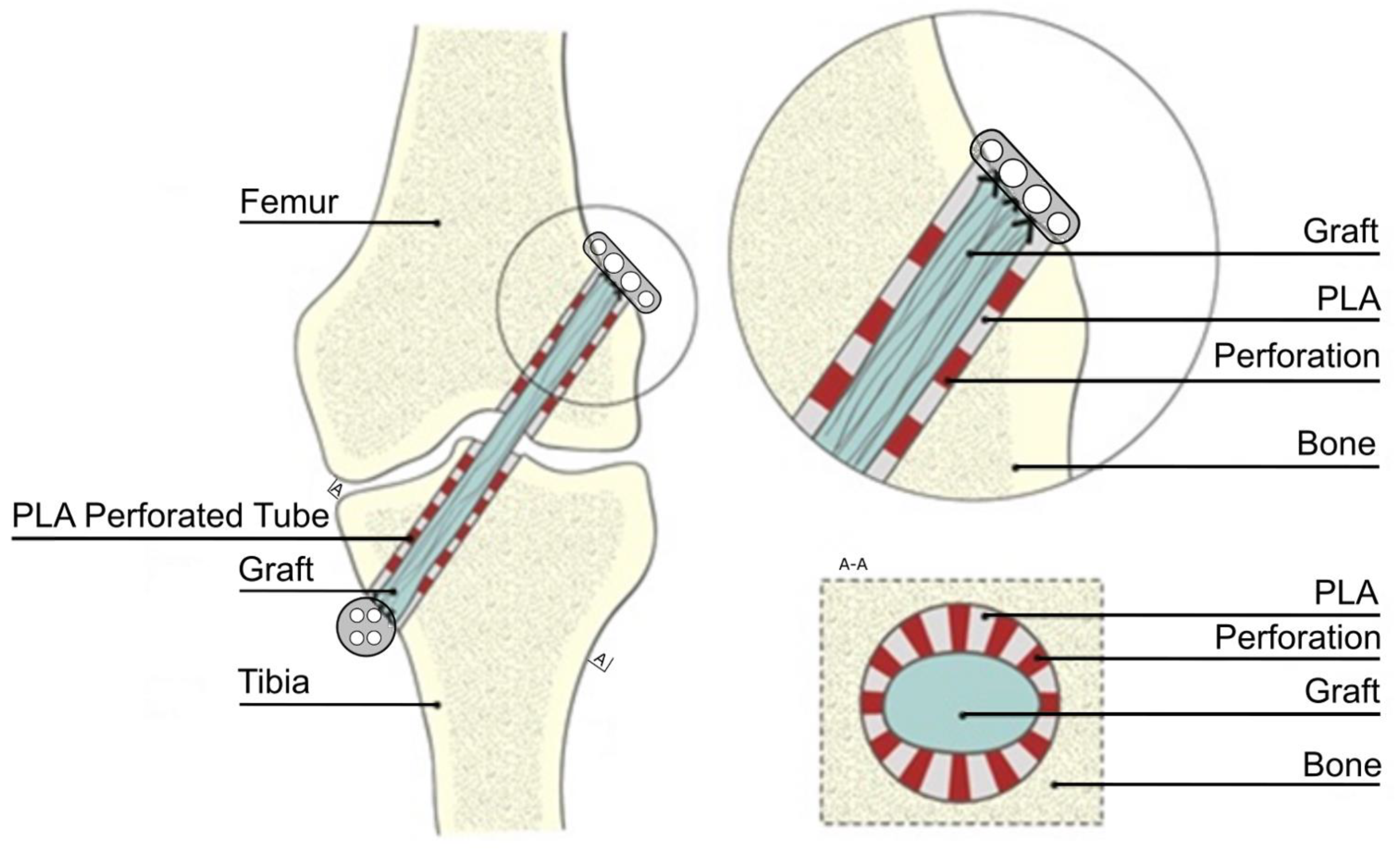 Polymers | Free Full-Text | Bioresorbable Stent In Anterior Polymers | Free Full-Text | Bioresorbable Stent In Anterior