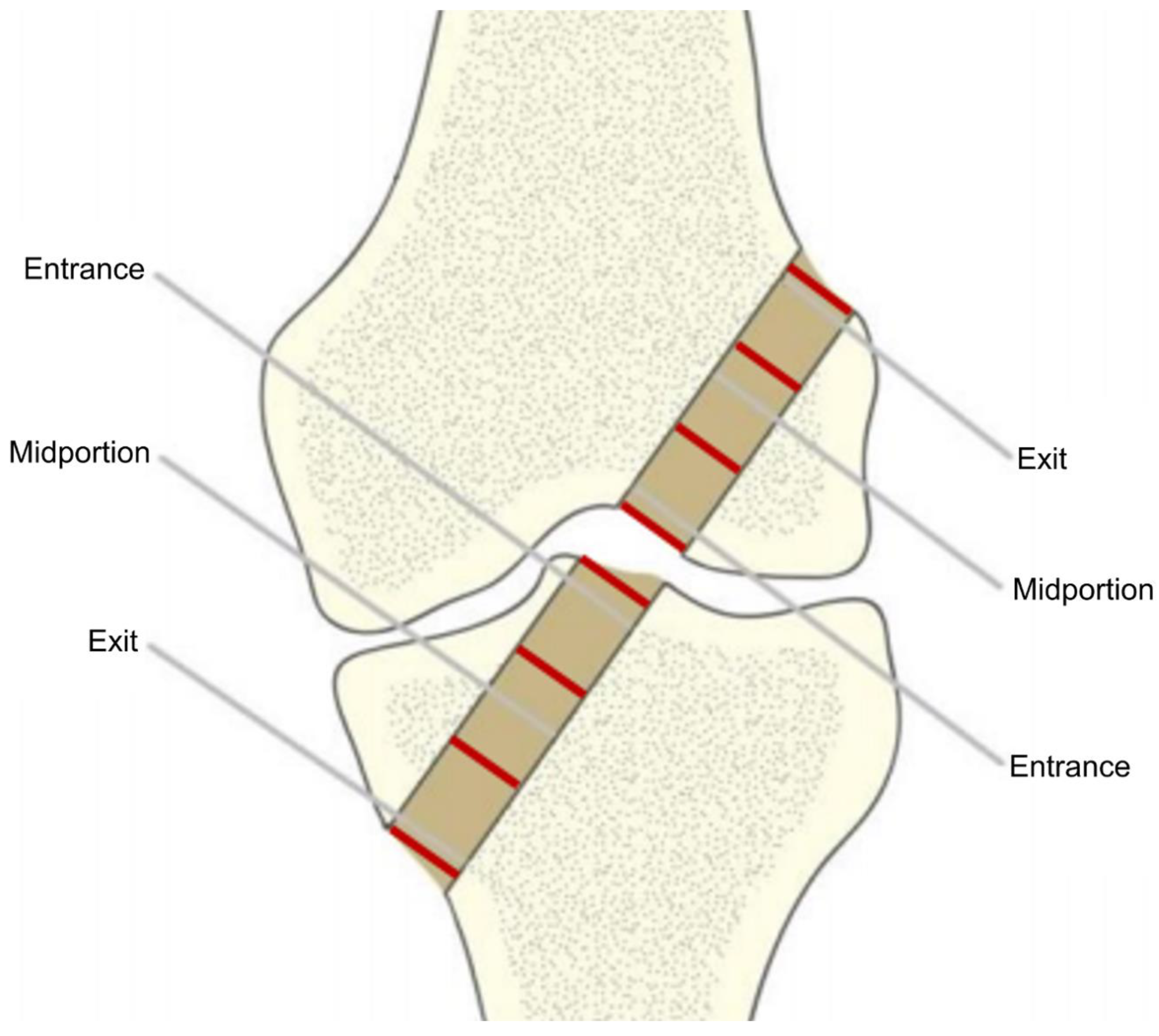 Polymers | Free Full-Text | Bioresorbable Stent In Anterior Polymers | Free Full-Text | Bioresorbable Stent In Anterior